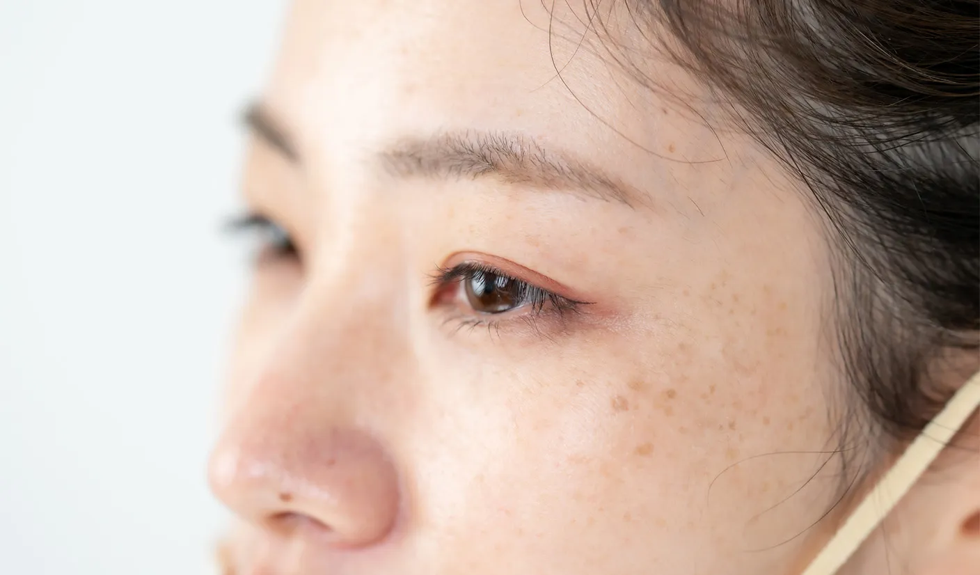 しみ・あざのイメージ写真